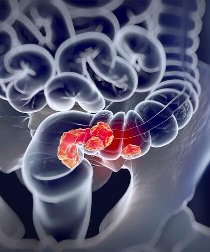 Mart Ayı Kolorektal Kanser Farkındalık Ayı: Ücretsiz Tarama Hayat Kurtarıyor