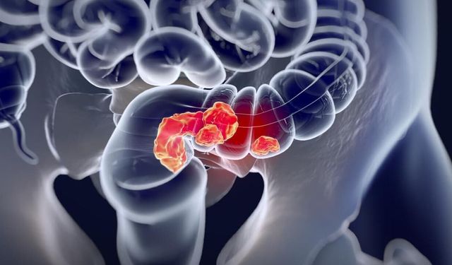 Mart Ayı Kolorektal Kanser Farkındalık Ayı: Ücretsiz Tarama Hayat Kurtarıyor