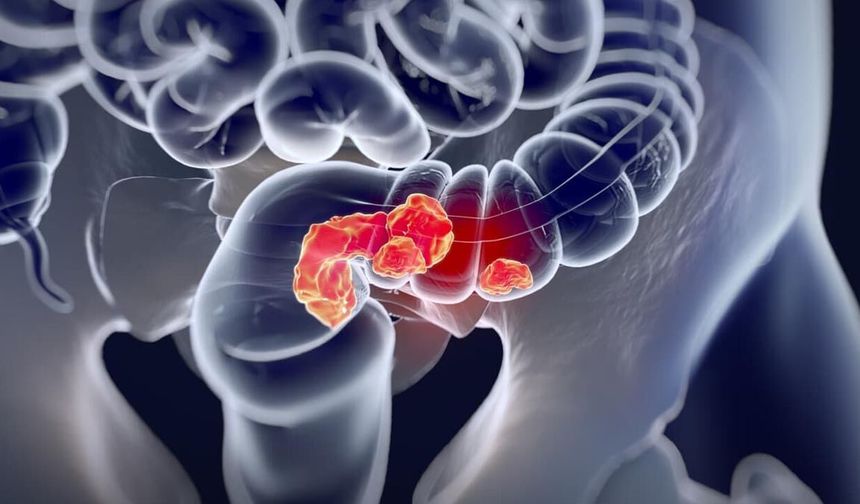 Mart Ayı Kolorektal Kanser Farkındalık Ayı: Ücretsiz Tarama Hayat Kurtarıyor