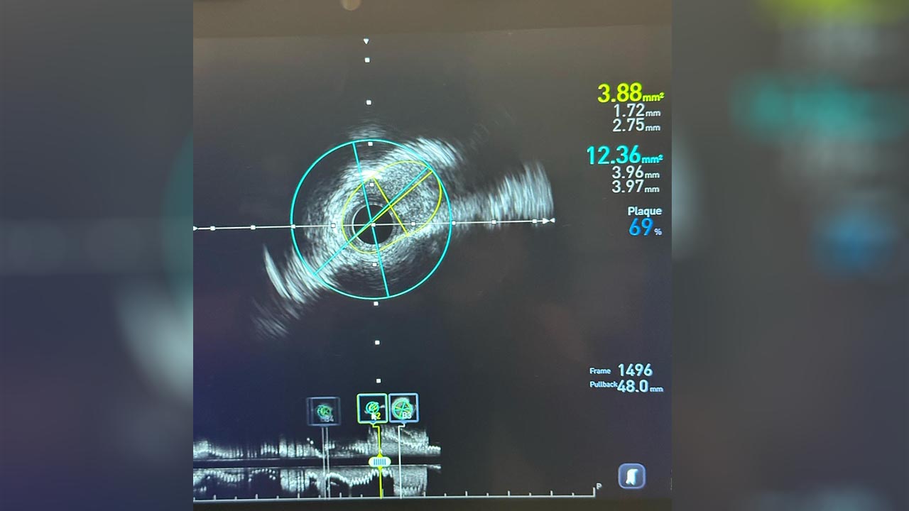 Yalova Hastane Kardiyoloji Ivus Kalp Ameliyat(2)