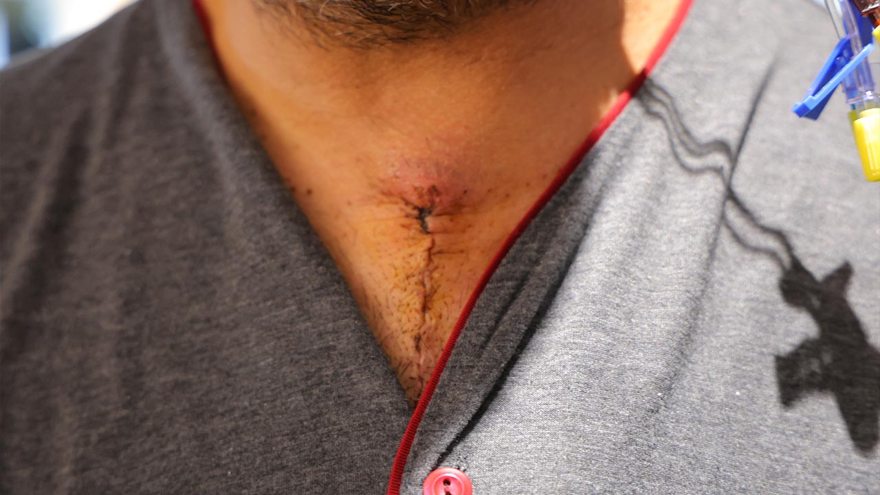 20 Dakika Beyin Dolaşımı Durdurulan Hasta Hayata Döndürüldü Haber (4)