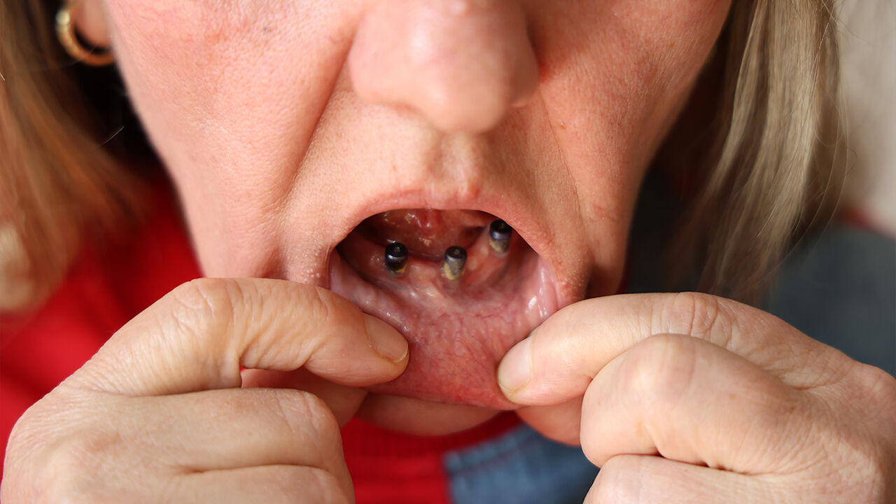 Diş Ağrısı Şikayetiyle Gitti 25 Dişinden Oldu (4)